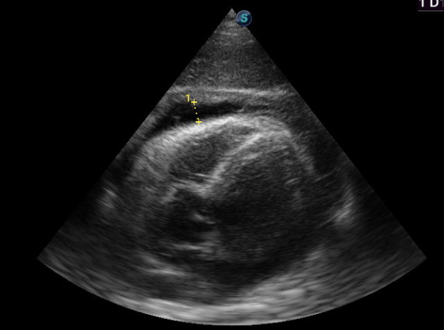 的患者超声见心包积液,右心室舒张受影响