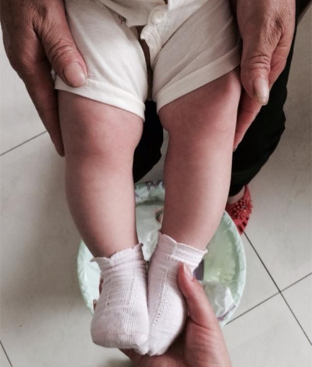 新生儿腿弯弯的,会是"罗圈腿"吗?家长需分清不同原因