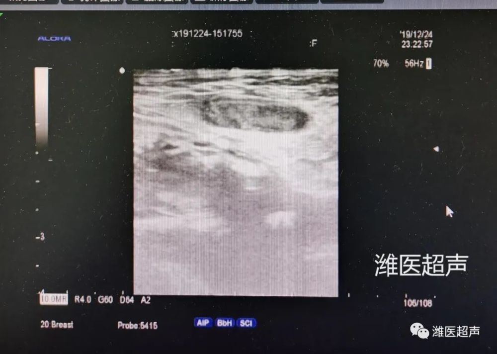 右侧腹股沟区可见一低回声包块,边界清,呈椭圆形