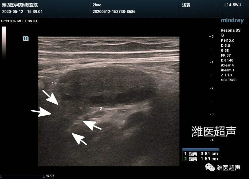 特殊类型的疝-卵巢疝的超声诊断