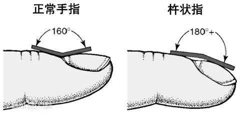 3,杵状指