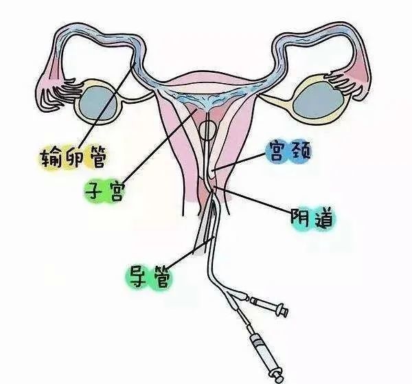 【女性备孕指南】输卵管通水后为什么没有怀孕?通水和