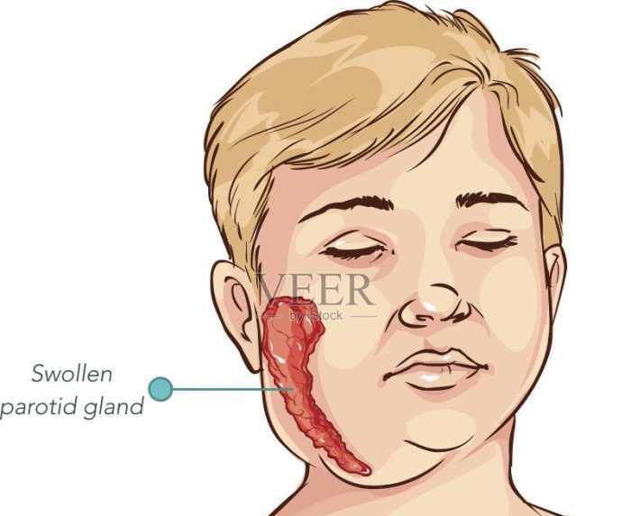 腮腺炎的症状与治疗