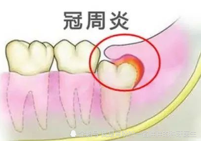 4.牙周炎,牙周脓肿