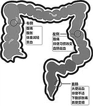 35岁男子突发肠癌离世,曾有肛周瘙痒,这是信号吗?该如何预防