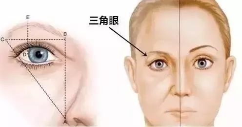内切,外切祛眼袋, 玻尿酸或自体脂肪填充泪沟等 03多重睑及三角眼