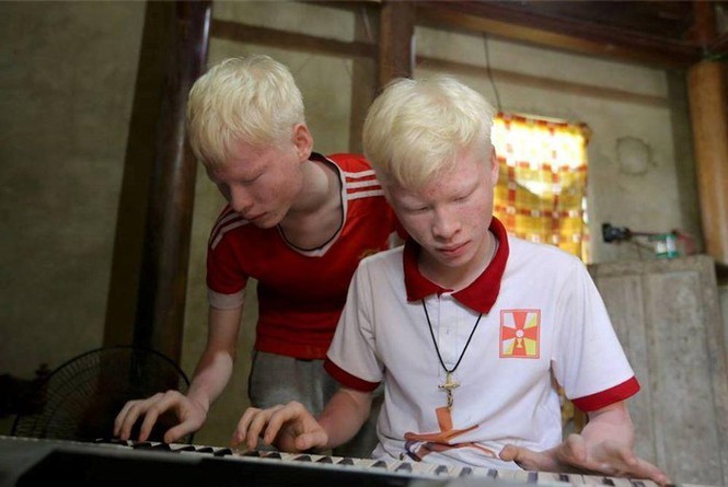 白化病双胞胎因视力减退被迫辍学,如今开始在线唱歌赚钱养家