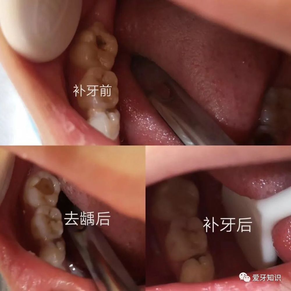 牙齿上出现黑线,这说明牙齿长蛀牙了吗?