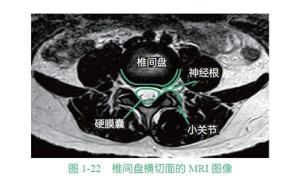 如何判断椎间盘突出严重程度从这几种表现出来的症状去判断