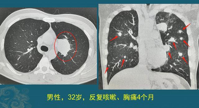 查出肺结节,有些是癌细胞入侵,医生教你用ct片找出恶性肺结节