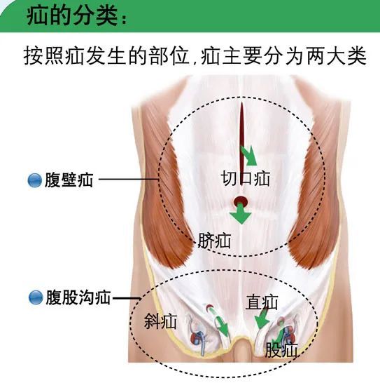 2 家长怎么判断宝宝是否有"疝气"?