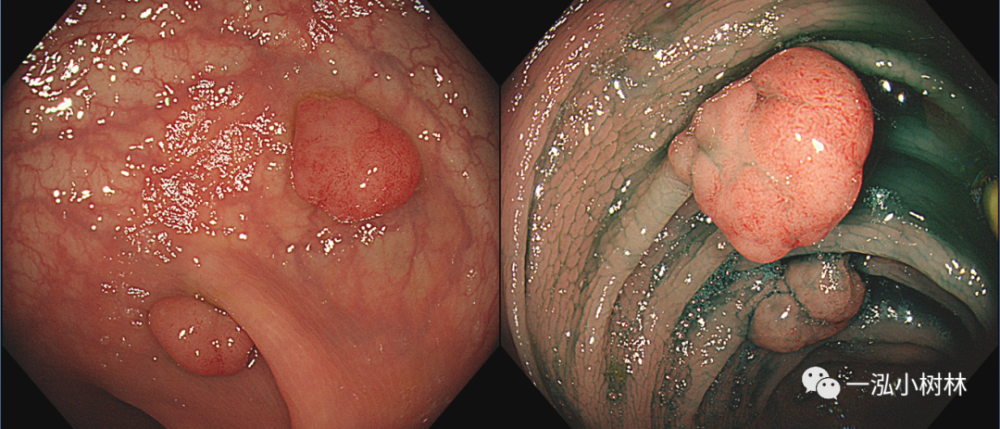 图34 结肠绒毛管状腺瘤 hgin(pit pattern iv型 cf-h260ai)