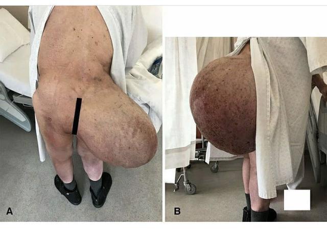 我们首先来看一个案例,这是一位90岁的患者,他腿上的脂肪瘤已经超过