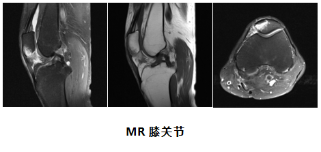 mr提示髌骨下份骨折伴骨髓水肿.左髌上囊,关节腔,髌下深囊积液.