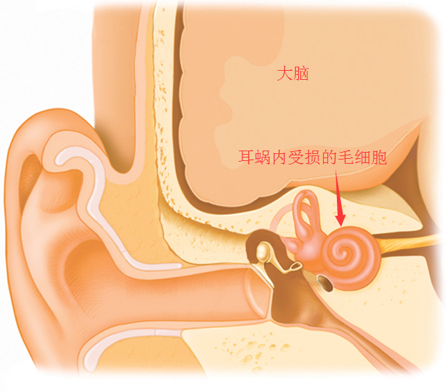民生耳鼻喉医院:当耳蜗毛细胞受损时可导致耳聋