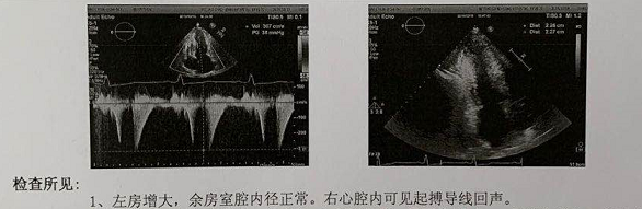 临床中最常用的检查手段是超声心动图:检查:超声心动图左心房的大小