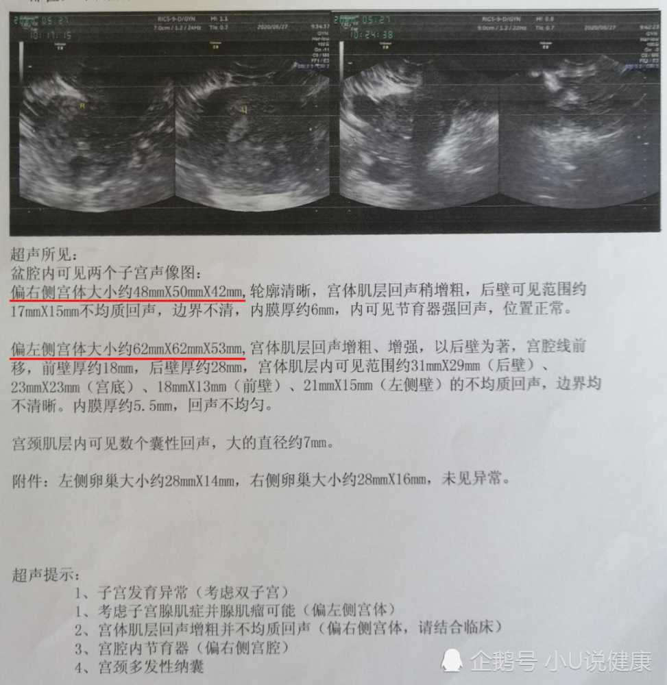 湖北双子宫腺肌症患者,患病12年,痛经了12年,王斌保宫