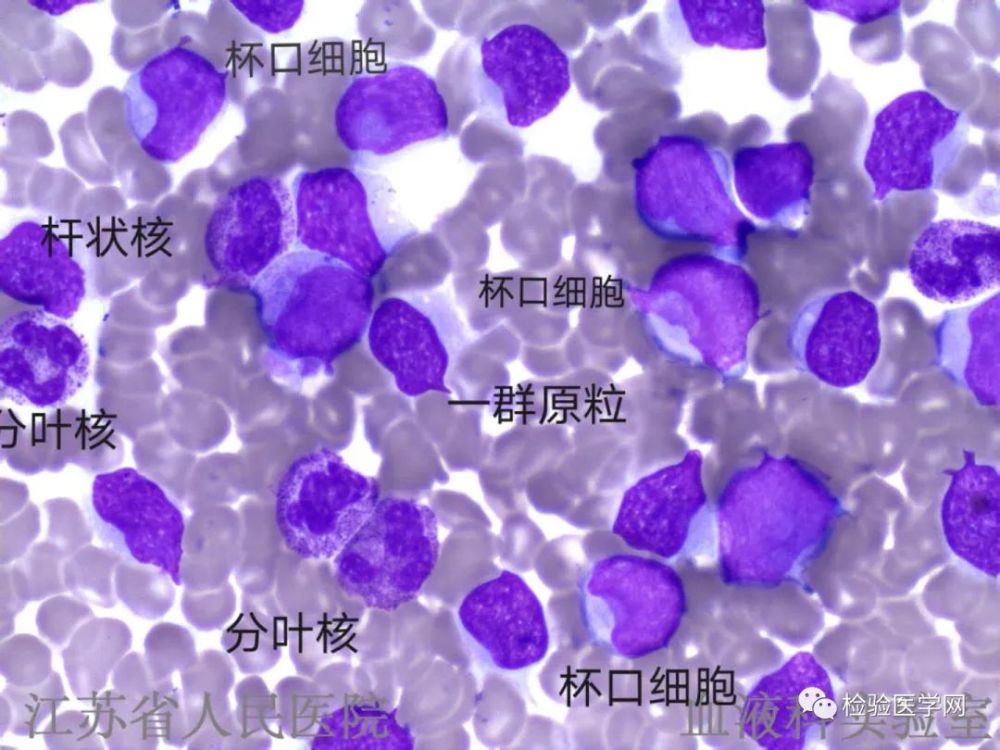 染色图片 左右 01 杯口(cup like nucleicell)细胞定义
