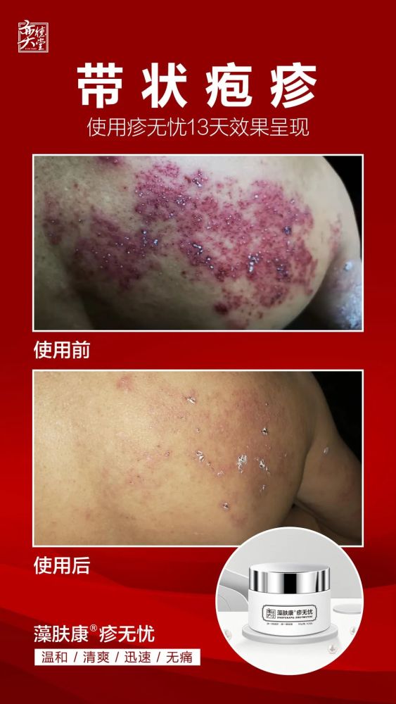夏季湿热，当心带状疱疹来“纠缠”？这招轻松“制伏”！