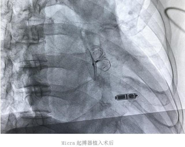 青岛首例无导线起搏器成功植入心律失常患者体内