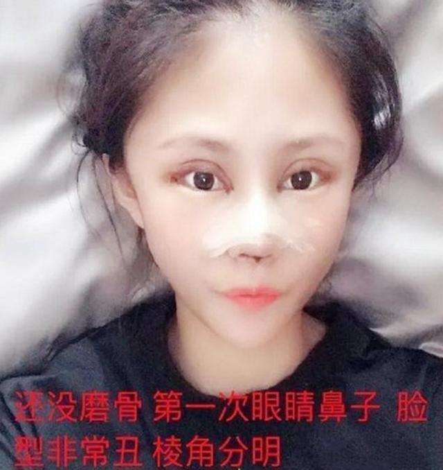 16岁女孩整容上瘾，光是在脸上3年整了近百次，老师：已无童真