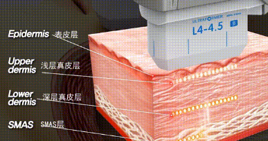 超声刀副作用严重?超声刀做完脸疼几天,哦买噶!