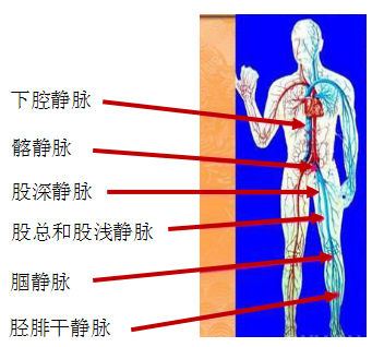 深静脉血栓可发生于全身静脉系统,多见于下肢深静脉,左侧下肢多见