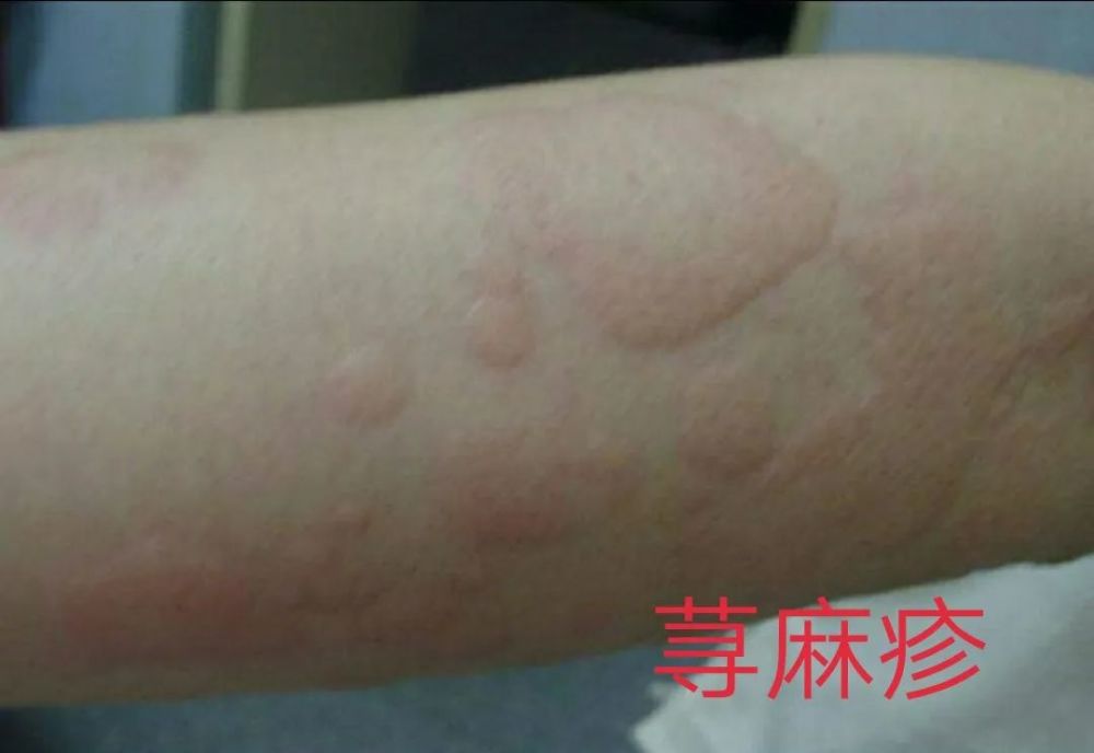 荨麻疹痒到生无可恋？试试艾灸曲池穴