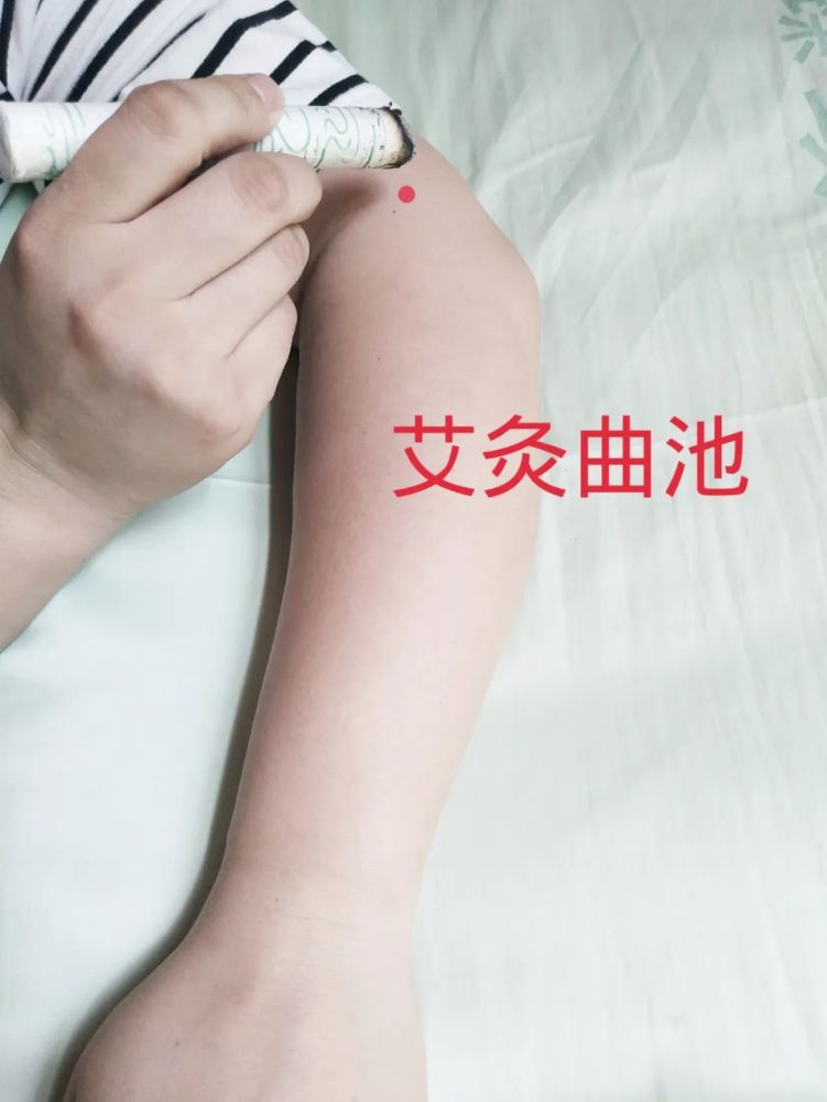 荨麻疹痒到生无可恋？试试艾灸曲池穴