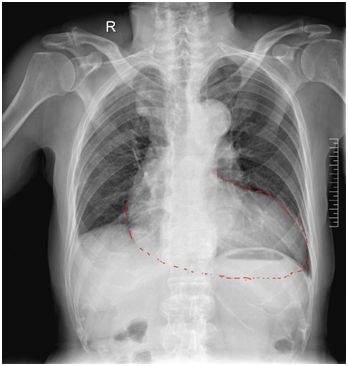 图1. 胸片,红色虚线示心脏横位.