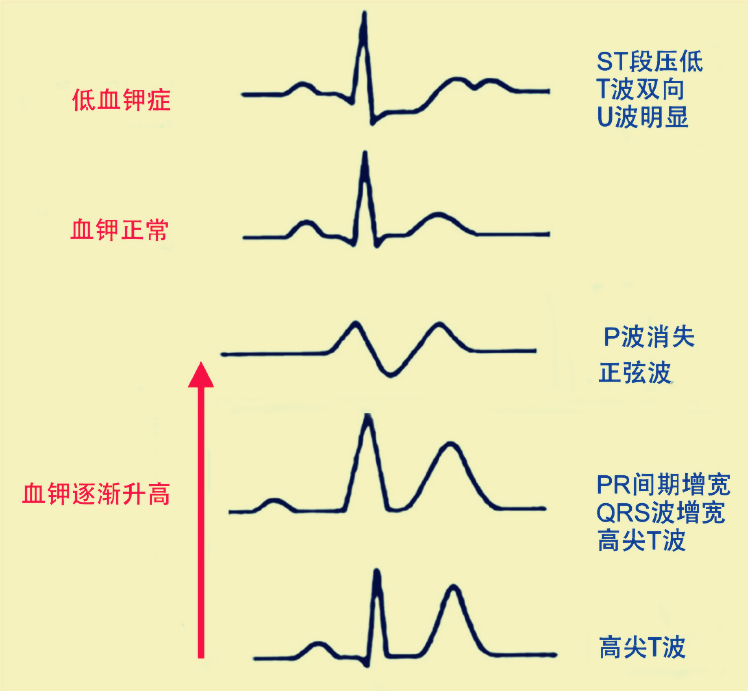 高钾血症时选择葡萄糖酸钙还是氯化钙文末附治疗口诀