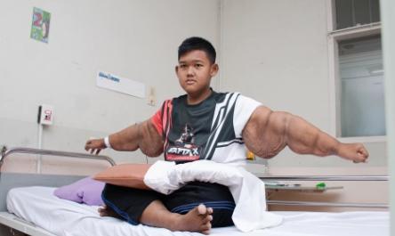印尼14岁“世界最胖男孩”减200斤后皮肤松弛如老太，将手术切除