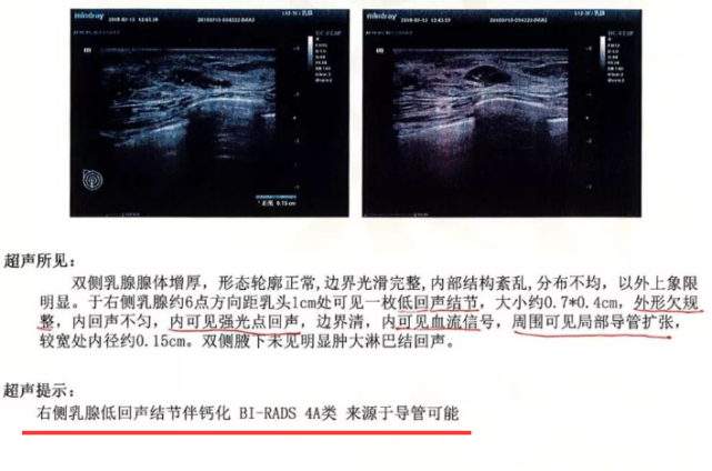 乳腺低回声结节,一个信号,或暗示癌变!