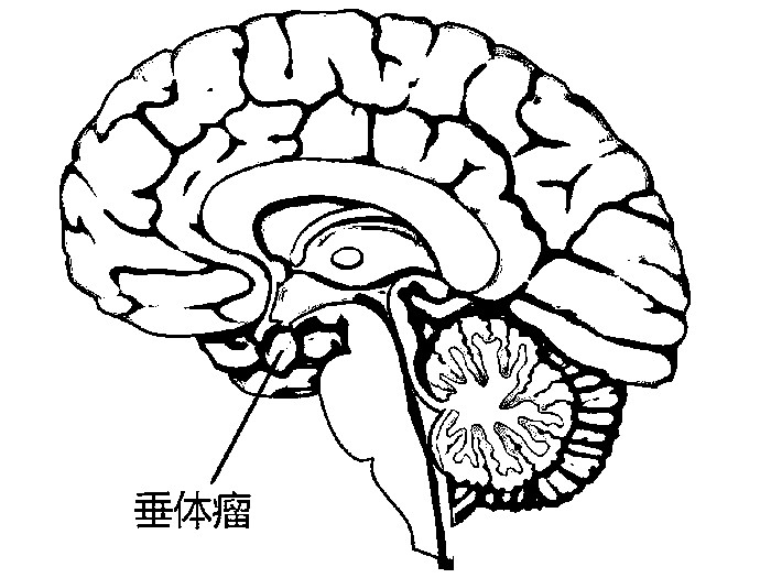 垂体瘤是神经外科比较多见的疾病,70%以上的患者属于无功能腺瘤.