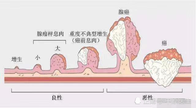 结直肠癌早期无症状,只能靠体检发现