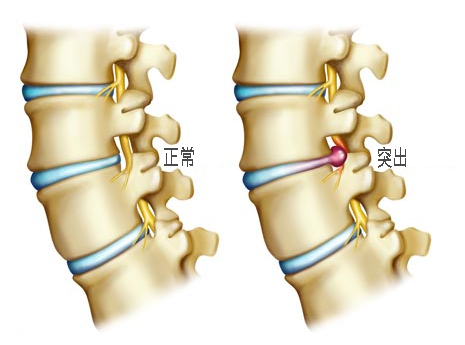 腰疼腿麻,难道是得了腰椎间盘突出?