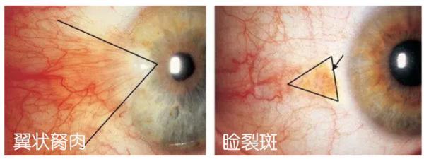 结膜出血[ jié mó chū xuě ]症状:「球结膜出血」是结膜血管破裂