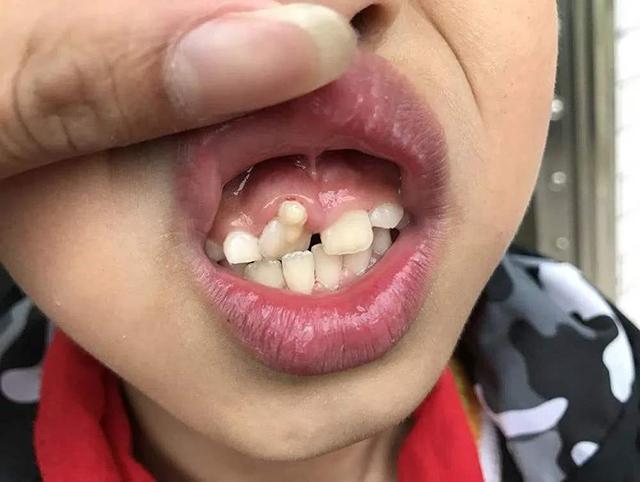 6岁孩子长出"双排牙",父母爱孩子的行为,却变成了"害"