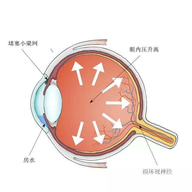 青光眼可以分为两种,开角型青光眼和闭角型青光眼.