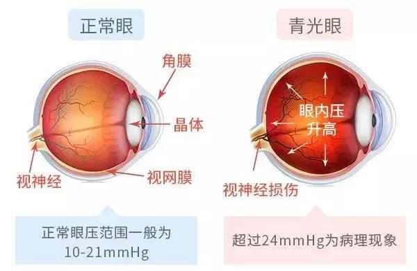 头晕,眼胀,视力下降,小心青光眼!