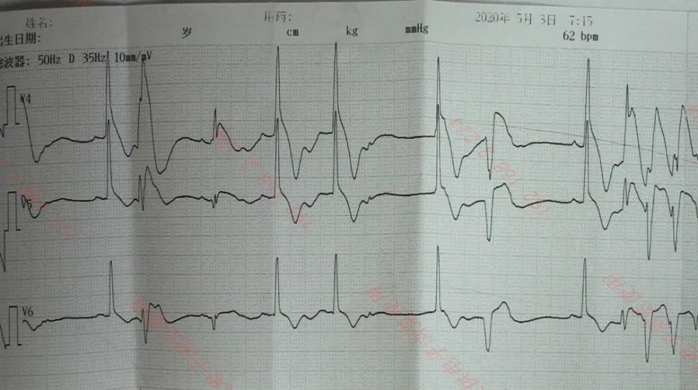 除颤8次,靠10张心电图把她救回来了