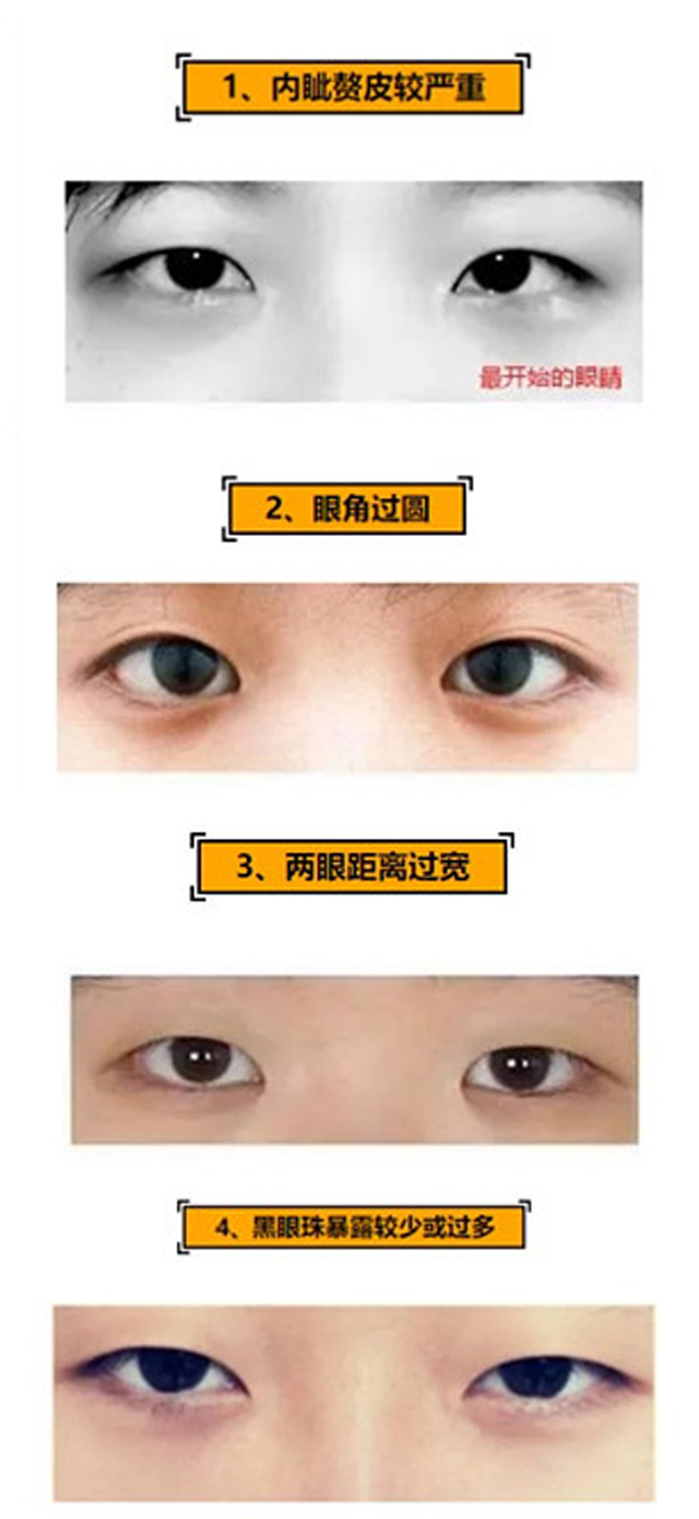 需不需要开内眼角关键在这!