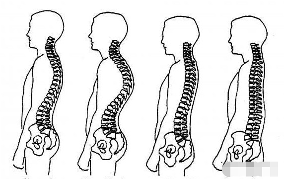 骨盆后倾的情况下,腰椎曲度变直,身体为了维持平衡,胸椎曲度会变大
