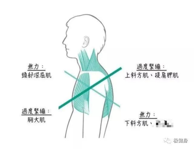 首先是深层颈屈肌因为头前引的缘故被过度拉伸而无力 其次下斜方肌和