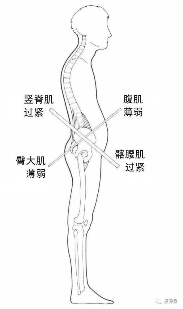 你是不是骨盆前倾？你需要思考一下下交叉综合症