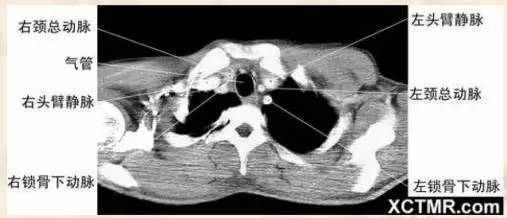影像解剖▕胸部