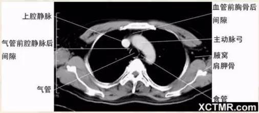 奇叶-奇静脉弓-胸膜分布肺段划分肺窗胸部解剖点击上方蓝字关注我们吧