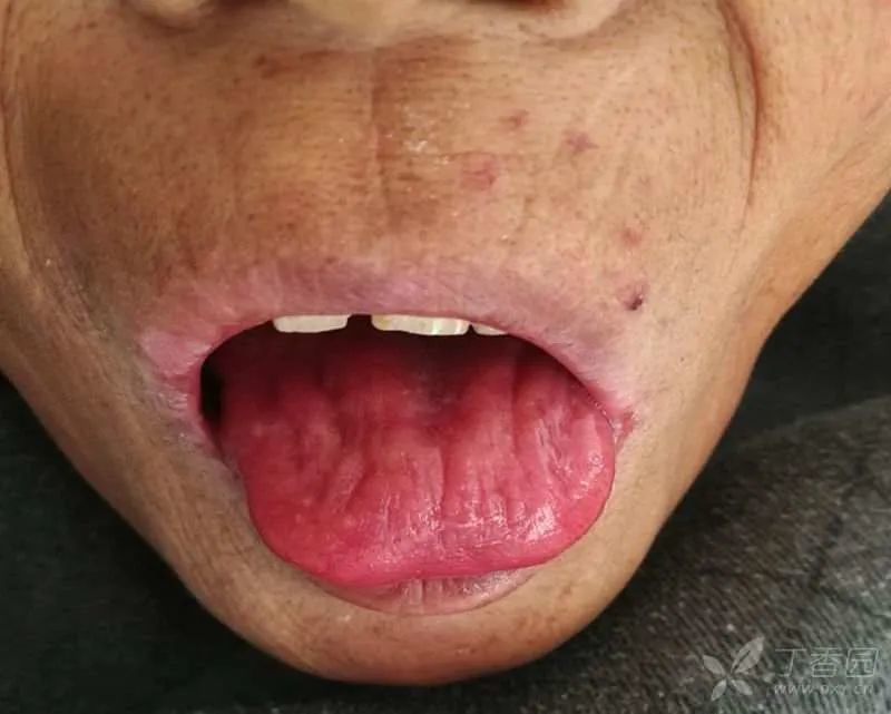 戒酒6 年后突发肝功能异常?呕血,黑便,全身多脏器系统