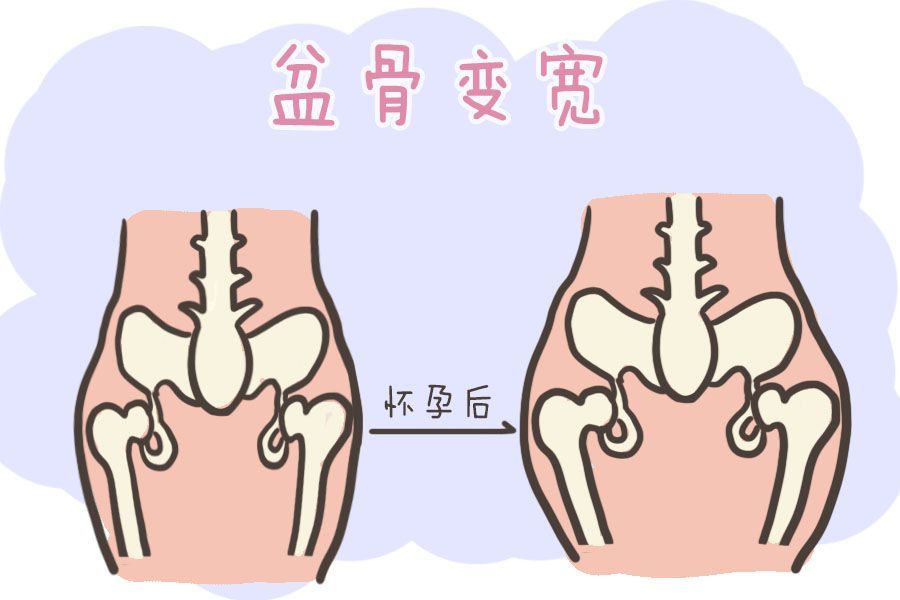 产后胯变宽了做骨盆修复就能好大错特错这只不过是一场骗局