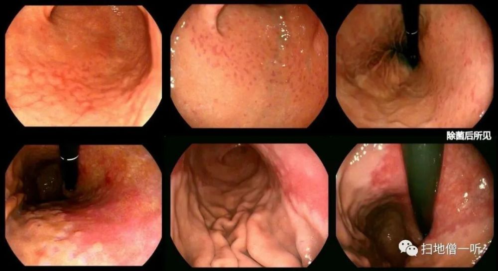 医学美图:标准胃镜检查m路径法